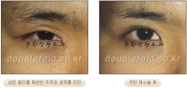 쌍꺼풀수술 두한성형외과 - 쌍커풀재수술의 문제점 관련 이미지 27