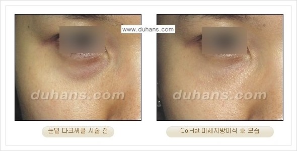 [두한성형외과 경쟁력 미세지방이식] - [지방이식 특허 Col-fat 미세지방이식 성공사례 안내] 관련 이미지 5