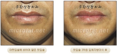 [두한성형외과 입술성형] - [볼륨감 있는 입술 미세지방이식] 관련 이미지 24