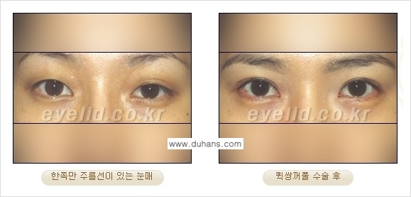 ​[두한성형외과 경쟁력 눈성형] - [자연스러운면서 매력적인 쌍꺼풀 퀵 쌍꺼풀 수술 안내] 관련 이미지 26