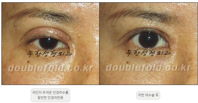 [Duhan Plastic Surgery Double Eyelid Revision] - [Thick Double Eyelid Line] image 42