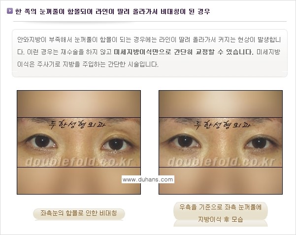 [두한성형외과 경쟁력 눈성형] - [비대칭(짝짝이) 쌍꺼풀 라인 교정 안내 ②] 관련 이미지 8