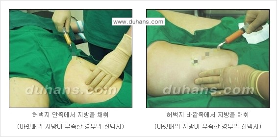 [두한성형외과 NO.1 지방이식]-[두한 지방이식 클리닉의 특징] 관련 이미지 6
