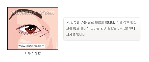 [두한성형외과 경쟁력 눈성형] - [앞트임 수술(몽고주름 제거) 안내 ②] 관련 이미지 7