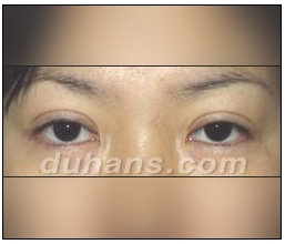 Candidates for Double Eyelid Revision Surgery: Unattractive Double Eyelids, Beautiful Double Eyelids image 15