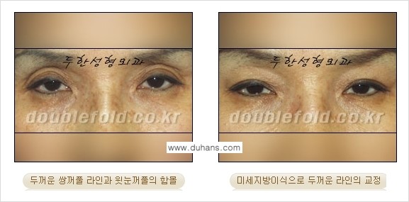 [두한성형외과 경쟁력 눈성형] - [미세지방이식으로 두꺼운 쌍꺼풀 라인의 교정 방법 안내] 관련 이미지 6