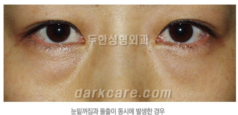 두한성형외과 눈밑성형 - 눈밑지방제거, 눈밑주름, 눈밑지방재배치 관련 이미지 95