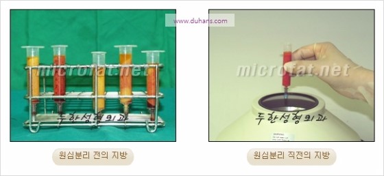 [두한성형외과 경쟁력 윤곽성형] - [볼, 볼살 지방이식] 관련 이미지 7