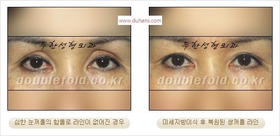 [두한성형외과 경쟁력 눈성형] - [풀려버린 쌍꺼풀 교정 방법] 관련 이미지 12