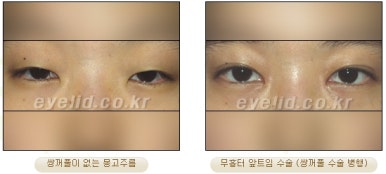 [Duhan Plastic Surgery Eyelid Surgery] - [Epicanthoplasty, Medial Canthoplasty] image 11
