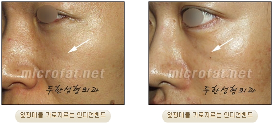 [Facial Autologous Fat Grafting, Duhan Plastic Surgery] - [Indian Wrinkle] image 3