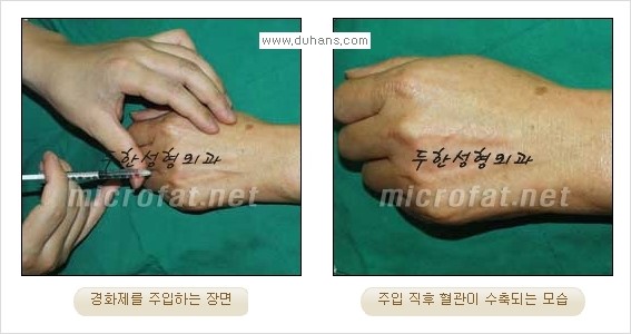 [두한성형외과 경쟁력 정맥류 치료] - [손, 손등, 손목혈관확장증, 팔혈관확장증에 질문과 답변] 관련 이미지 5