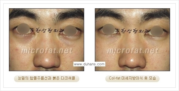 [두한성형외과 경쟁력 눈밑성형] - [눈밑 다크써클과 눈밑 함몰주름의 최적화 교정방법 안내] 관련 이미지 15
