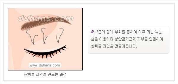 [두한성형외과 경쟁력 눈성형, 쌍꺼풀 수술] - [퀵쌍꺼풀(부분절개법)의 수술 안내] 관련 이미지 10