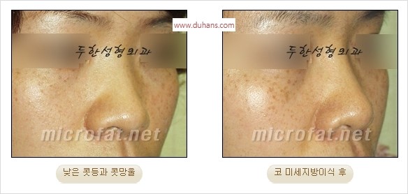 [두한성형외과 경쟁력 지방이식] - [두한 자가지방이식 클리닉 안내]​ 관련 이미지 39