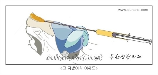 [두한성형외과 경쟁력 코성형] - [미세지방이식을 이용한 자연스러운 코성형 안내] 관련 이미지 1