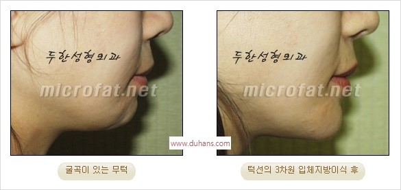 [두한성형외과 경쟁력 안면윤곽 교정] - [자연스럽고 균형있는 턱으로의 복원 미세지방이식과 간편 사각턱 보톡스 안내] 관련 이미지 25