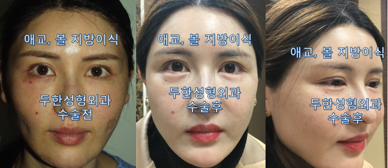 [두한성형외과 지방이식]-[#애교 #볼 #볼패임 #볼함몰 #실리프팅후볼패임 #실리프팅부작용] 관련 이미지 1