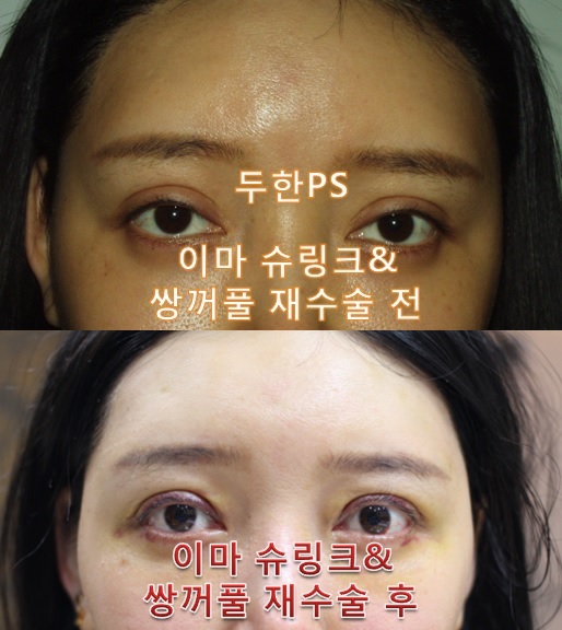 [두한성형외과 쌍꺼풀재수술, 이마슈링크]-[#라인낮추기 #소세지개선 #이마슈링크 #울퉁불퉁한이마개선] 관련 이미지 1