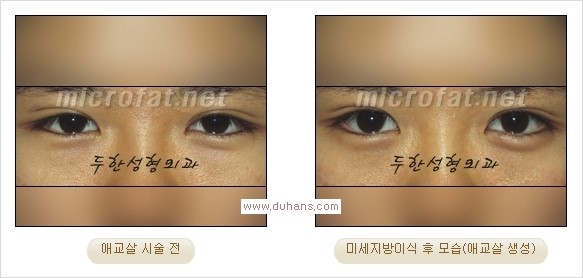 [두한성형외과 경쟁력 눈밑성형] - [타 병원 필러 애교살 시술 부작용을 미세지방이식으로 교정] 관련 이미지 24