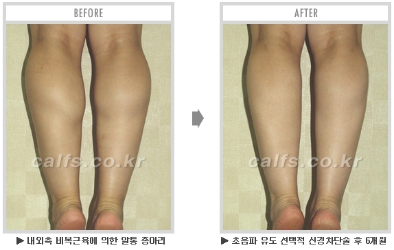 [종아리성형 두한성형외과] - [종아리수술에 대한 자주하는 질문과 답변 모음] 관련 이미지 63