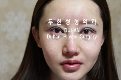 [DuHan Plastic Surgery Double Eyelid Surgery] - [Frequently Asked Questions and Answers About Eye Plastic Surgery] image 22