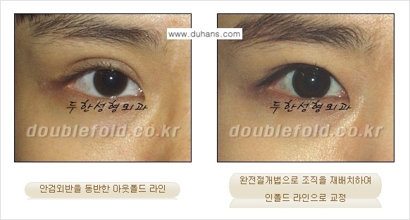 [두한성형외과 경쟁력 쌍꺼풀 재수술, 극한 눈재수술] - [심한 아웃폴드 라인을 인폴드 라인으로 교정 방법 안내] 관련 이미지 4