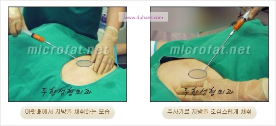 [두한성형외과 경쟁력 미세지방이식] - [측두부(관자놀이) 지방이식] 관련 이미지 2