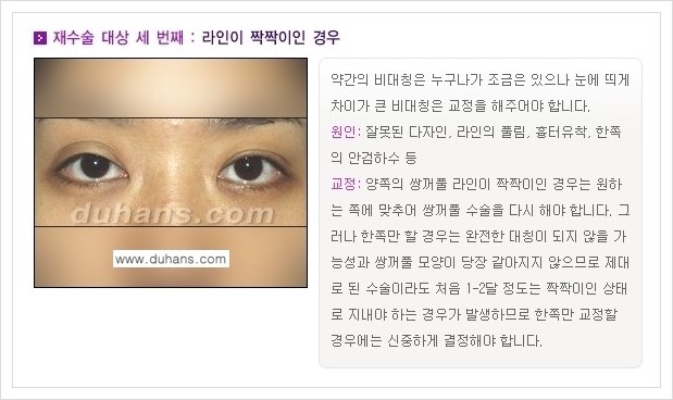 [두한성형외과 경쟁력 쌍꺼풀 재수술(극한 재수술)] - [쌍꺼풀 재수술 대상의 안내] 관련 이미지 3