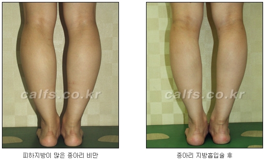 두한성형외과 지방흡입 - 부위별 안전 지방흡입 관련 이미지 36