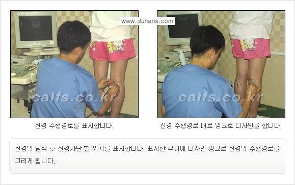 [두한성형외과 경쟁력 종아리성형] - [초음파 유도 선택적 신경차단술 안내 ②] 관련 이미지 5