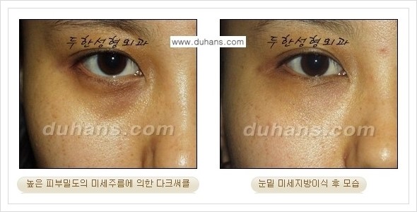 [두한성형외과 경쟁력 눈밑성형] - [다크써클과 눈밑주름을 위한 미세지방이식 안내] 관련 이미지 4