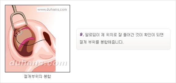 [두한성형외과 경쟁력 코성형] - [코성형을 위한 알로덤(슈어덤) 수술, 실리콘 수술 안내] 관련 이미지 12