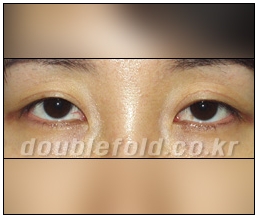 [두한성형외과 쌍커풀수술] - [눈성형 방법에 대한 자주하는 질문과 답변] 관련 이미지 202