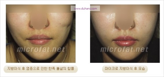 [두한성형외과 경쟁력 지방이식] - [두한 자가지방이식 클리닉 안내]​ 관련 이미지 79