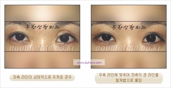 [두한성형외과 경쟁력 눈성형] - [비대칭 쌍꺼풀 라인의 여러 가지 교정 방법] 관련 이미지 5