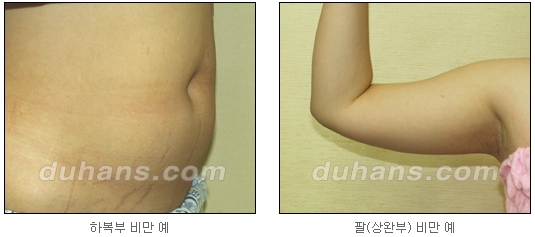 [Duhan Plastic Surgery Simple Liposuction] - [Liposuction for Obesity] image 2