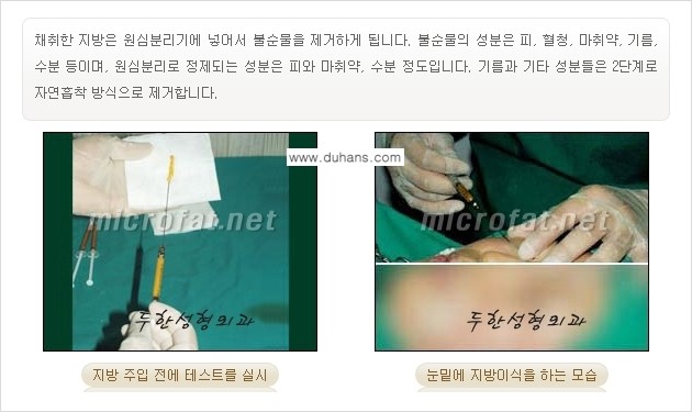 [두한성형외과의 경쟁력 있는 지방이식] - [눈밑 애교살 미세지방이식 1.] 관련 이미지 6