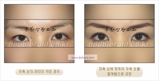 [두한성형외과 경쟁력 눈성형] - [쌍꺼풀 재수술에 대한 최선의 대안 제시] 관련 이미지 60