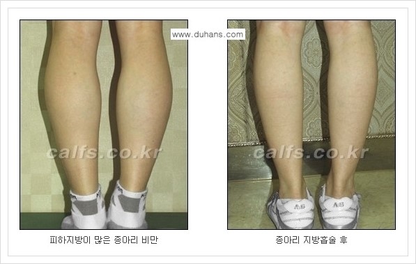 [두한성형외과 경쟁력 멀티종아리성형] - [예쁜 종아리를 만드는 종아리 지방흡입술 안내] 관련 이미지 14