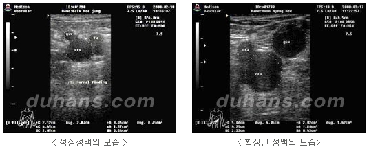 [두한성형외과 정맥류] - [하지정맥류, 정맥확장증, 혈관확장증] 관련 이미지 3