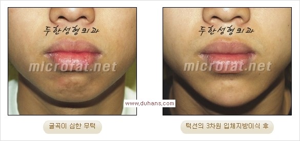 [두한성형외과 경쟁력 미세지방이식] - [부드럽고 아름다운 얼굴윤곽선 턱(하악부) 미세지방이식 안내] 관련 이미지 18