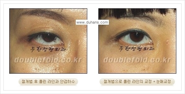 [두한성형외과 경쟁력 쌍꺼풀 재수술, 극한 재수술] - [쌍꺼풀 라인이 풀렸을 경우 쌍꺼풀 재수술 안내] 관련 이미지 5