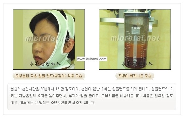 [두한성형외과 경쟁력 얼굴지방흡입] - [통통한 볼살, 두툼한 턱살(턱선)의 지방흡입] 관련 이미지 10