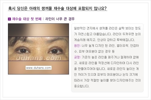 [두한성형외과 경쟁력 쌍꺼풀 재수술(극한 재수술)] - [쌍꺼풀 재수술 대상의 안내] 관련 이미지 1
