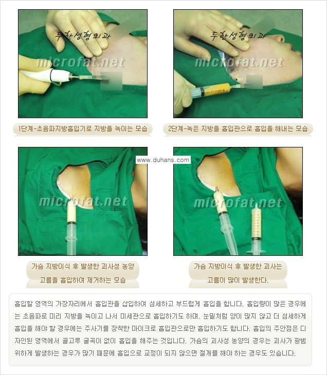 [두한성형외과 "미세지방이식"] - [지방이식 부작용 교정 정보 ②] 관련 이미지 4