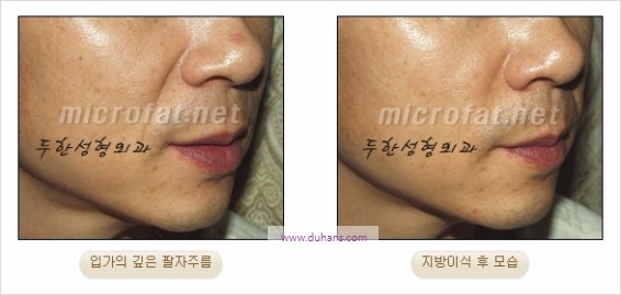 [두한성형외과 경쟁력 주름성형] - [젊어 보이는 입가팔자주름 지방이식] 관련 이미지 21