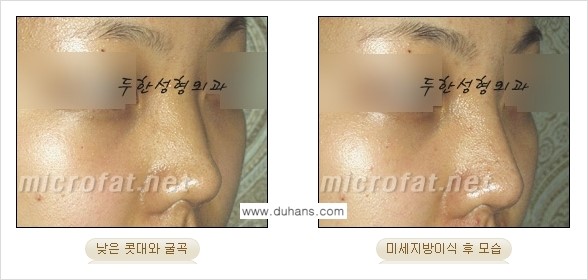 ​[두한성형외과의 No.1 경쟁력 미세(자가)지방이식] - [코높힘 미세(자가)지방이식 ②] 관련 이미지 15