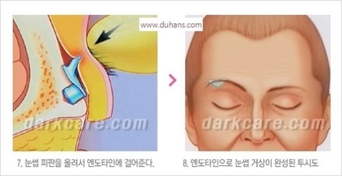 [두한성형외과 경쟁력 Quick 주름성형] - [주름제거, 탄력증대! 리프팅 시리즈 안내] 관련 이미지 30