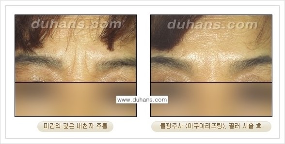 [두한성형외과 경쟁력 주름성형] - [미간주름, 눈가주름, 눈밑주름 제거 시술 안내] 관련 이미지 1